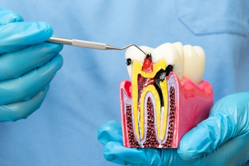 Root Canal Treatment in Albuquerque, NM | Affordable Dental Care