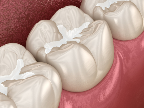 Dental Fillings in Albuquerque, NM | Affordable Cavity Treatment
