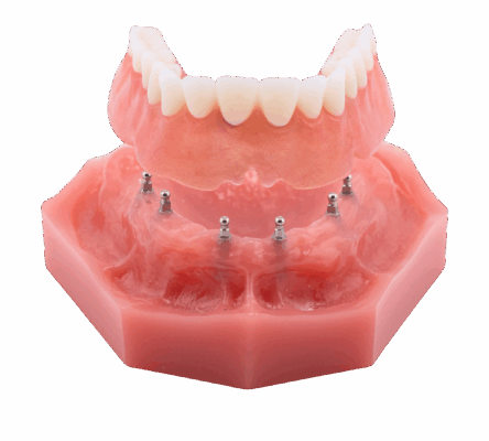 Implant Dentures in Albuquerque, NM | Book a Free Consultation