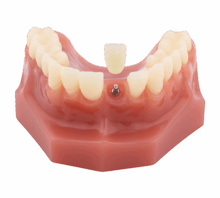 Mini implantes dentales en Albuquerque, Nuevo México | ¡Consultas gratuitas!