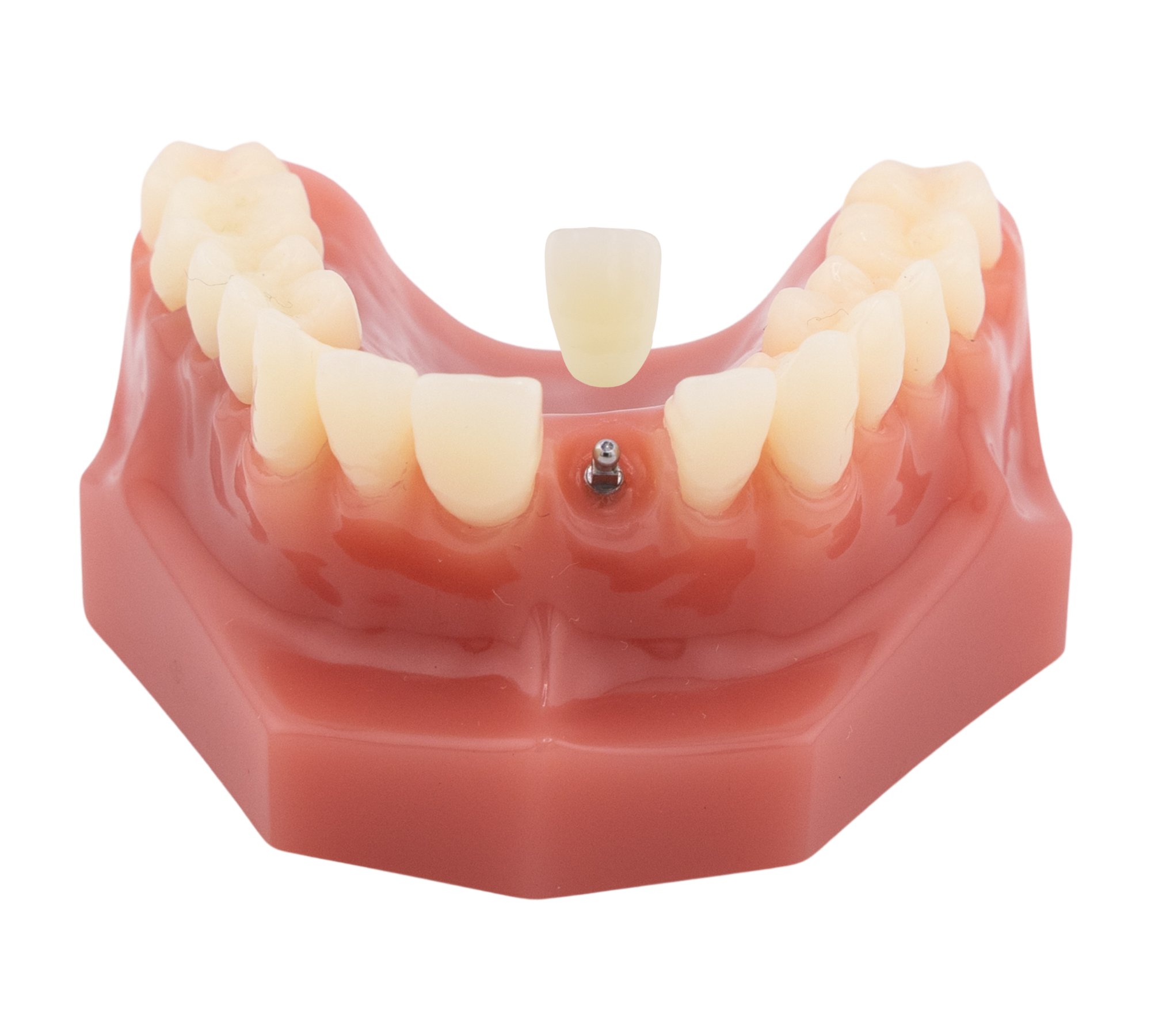 Mini Dental Implants in Albuquerque, NM | Free Consultations!