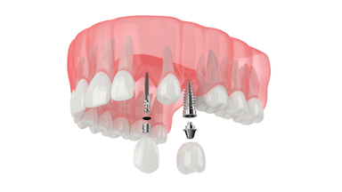Same-Day Dental Implants in Albuquerque, NM | Restore Your Smile With Mini Implants