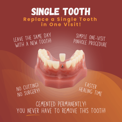 Single Tooth Replacement in Albuquerque