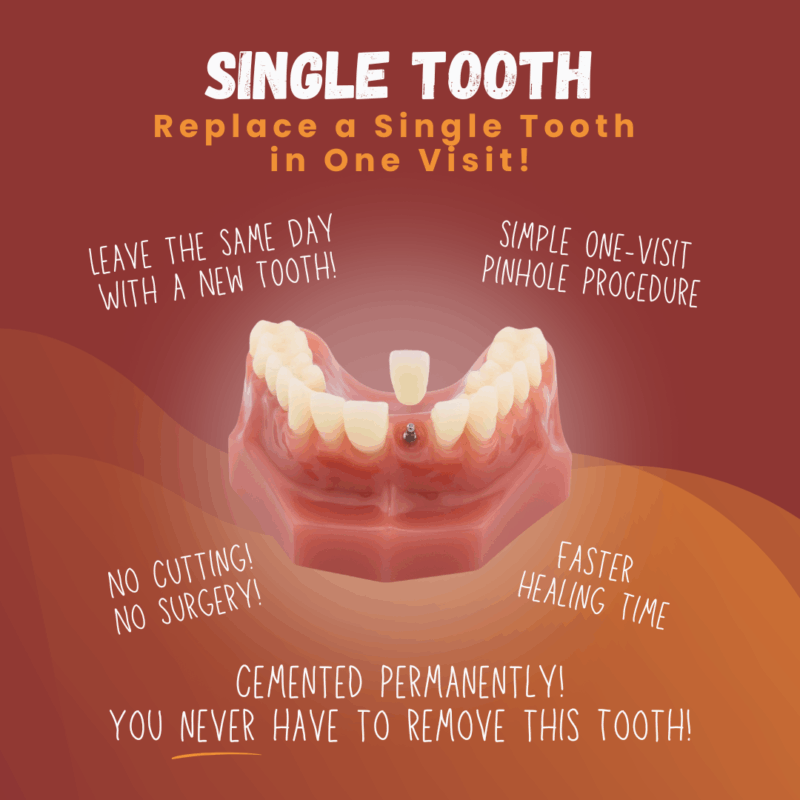Single Tooth Replacement in Albuquerque