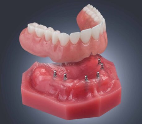 Floating Dentures | Affordable Implant Options in Albuquerque, NM
