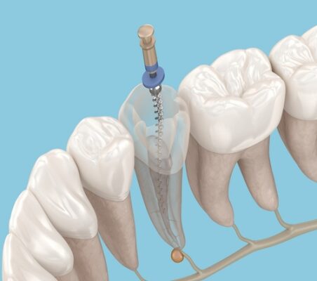 Root Canal Therapy in Albuquerque, NM | Affordable Dental Care