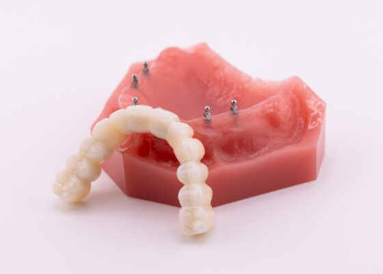 Fix-on-Six | Affordable Implant Dentures in Albuquerque, NM