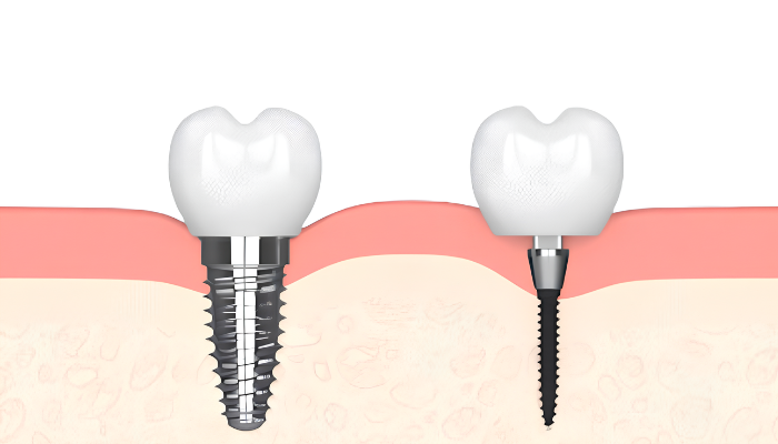 What Are Mini Dental Implants? | Free Consultations in Albuquerque, NM
