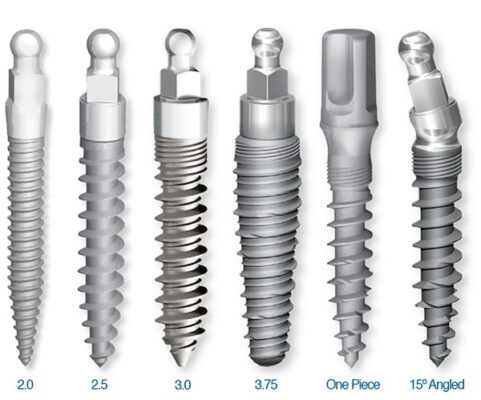 Best Implant Options in 2026 | Implant Dentist in Albuquerque, NM