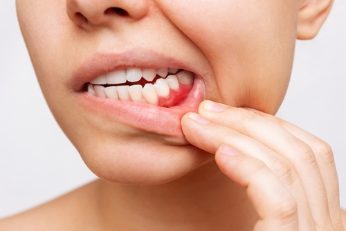 Bleeding Gums | Periodontal Treatment in Albuquerque, NM