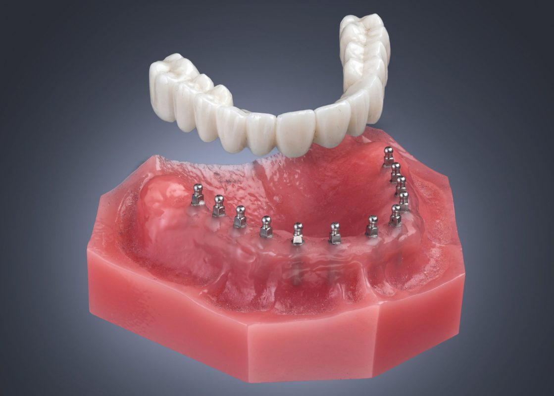 Roundhouse Bridge | Opciones de dentaduras postizas con implantes en Albuquerque, Nuevo México