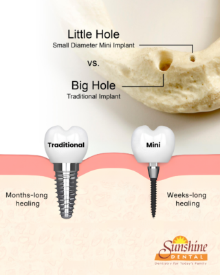 Mini Implant vs. Traditional Implant | Albuquerque, NM