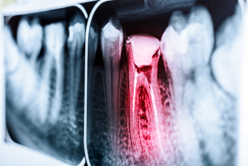 Root Canal Therapy in Albuquerque, NM | Relief for Tooth Pain