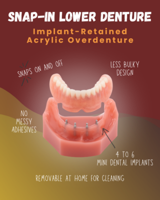 Snap-In Dentures in Albuquerque, NM | Free Consultation Near Me Lower Denture_1
