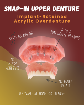Snap-In Dentures in Albuquerque, NM Free Consultation Near Me Upper Denture_2