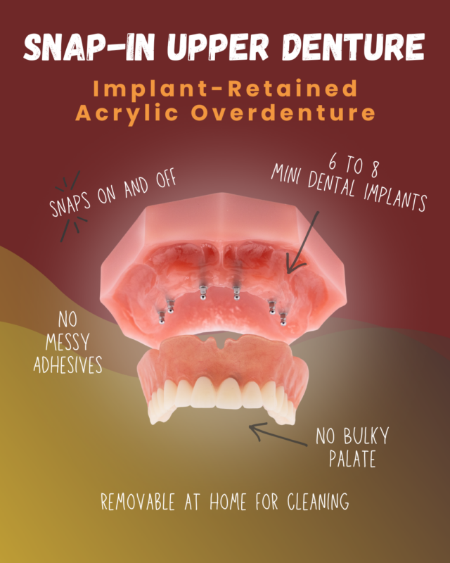 Snap-In Dentures in Albuquerque, NM Free Consultation Near Me Upper Denture_2