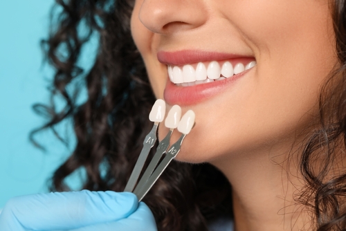 Porcelain Veneers in Albuquerque, NM | Book a Free Consultation!